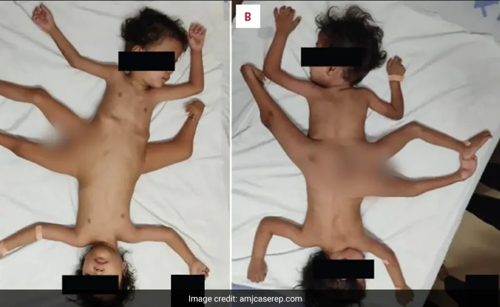 Spider Twins Born in Indonesia 2024: A Rare Medical Phenomenon